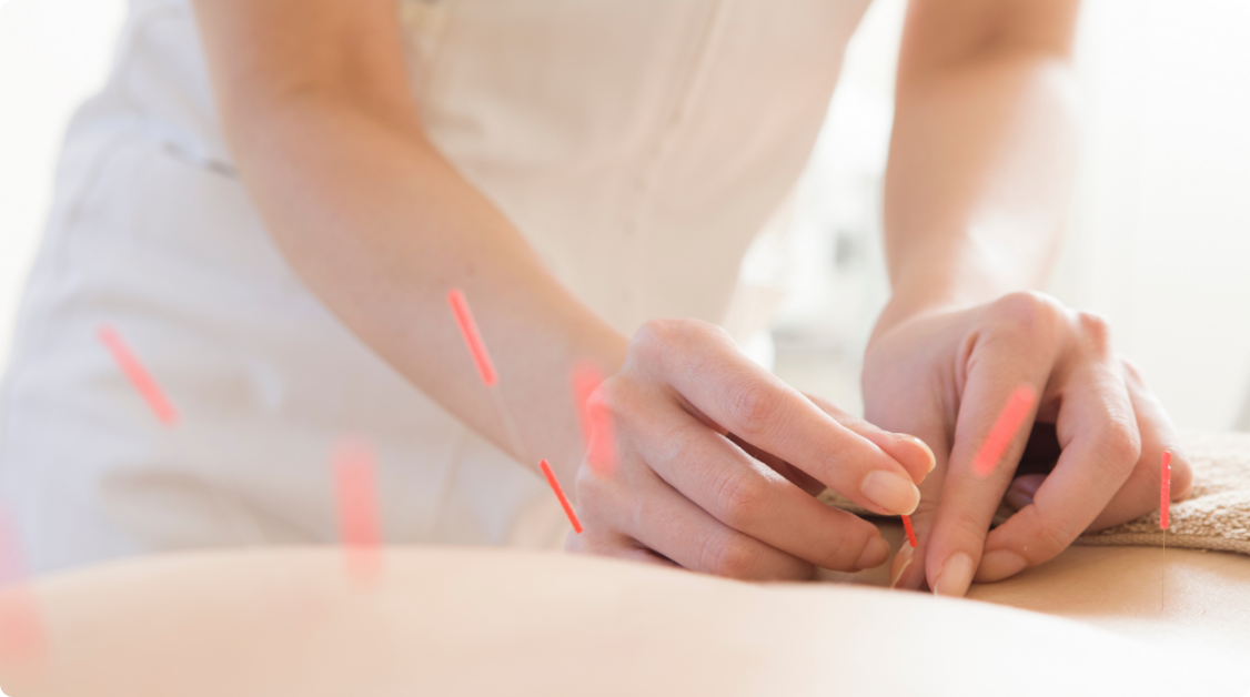 鍼灸治療の画像